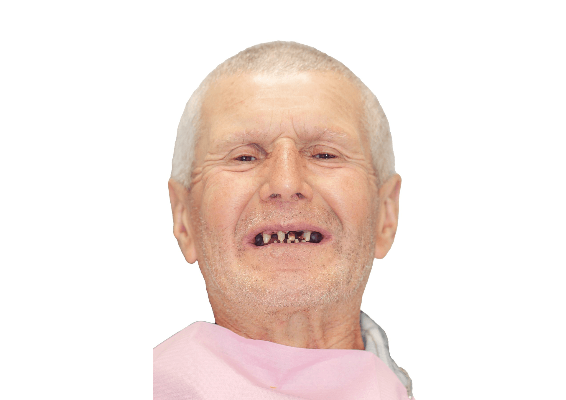 Reabilitare dentara - Before